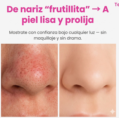 HydraPore™  Quita Puntos Negros con Doble Tanque de Agua